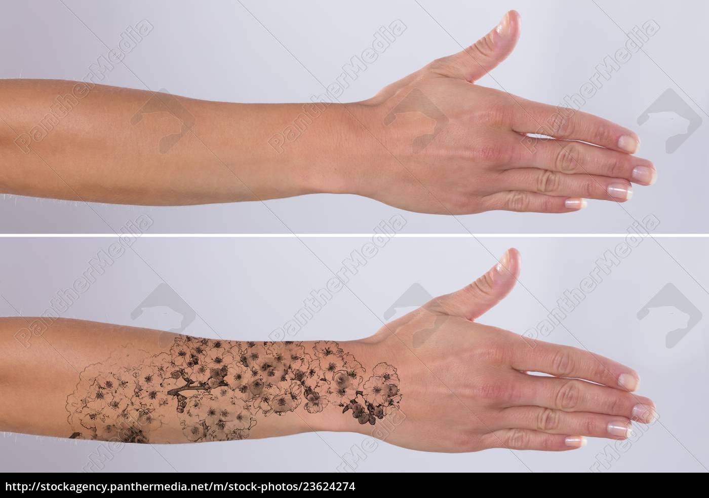 Remoção De Tatuagem Laser Na Mão Das Mulheres Foto de Stock - Imagem de  laser, interior: 214013894